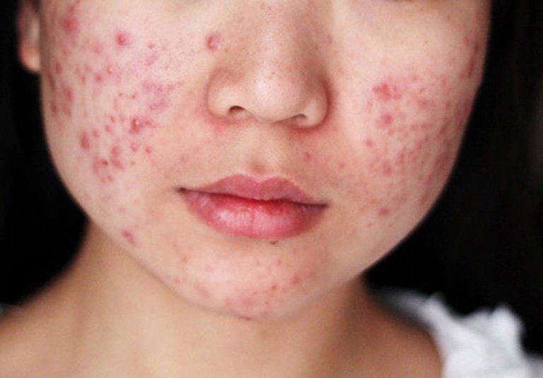 Mụn trứng c&aacute; nổi theo từng mảng