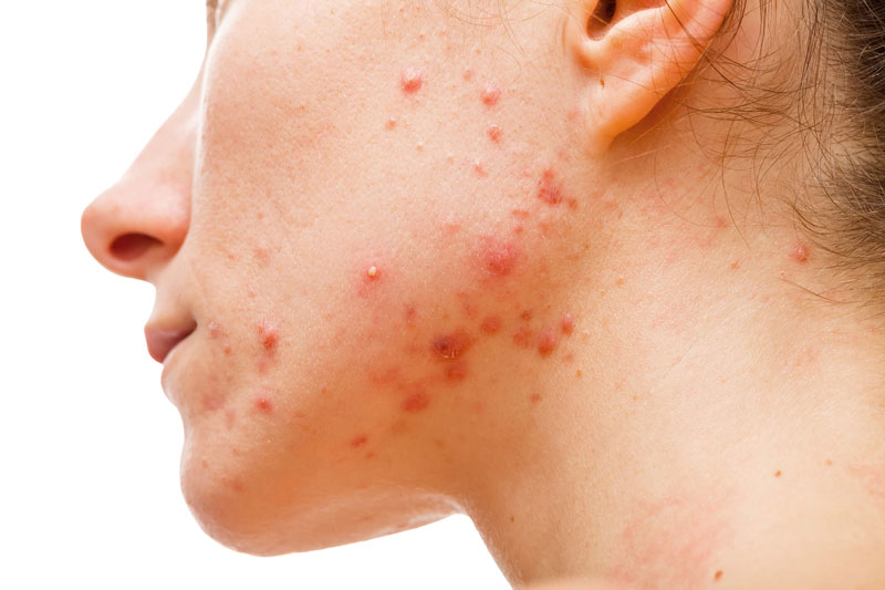 Mụn trứng c&aacute; h&igrave;nh th&agrave;nh do vi khuẩn Propionibacterium Acnes