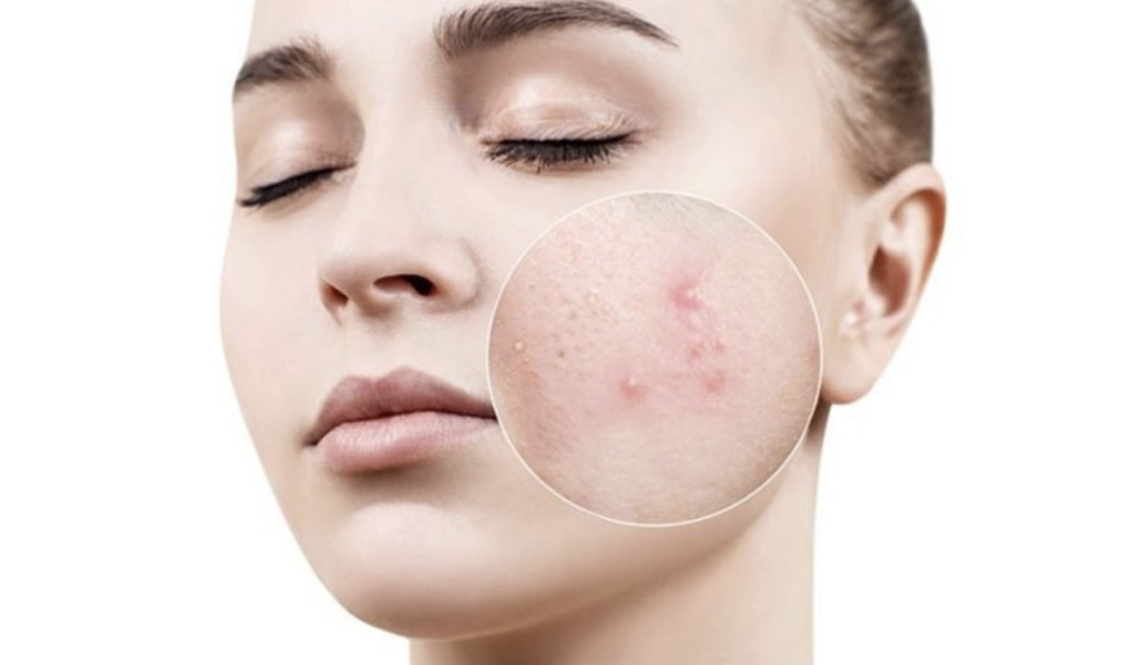 Mụn trứng c&aacute; thường g&acirc;y đau nhức v&agrave; sưng đỏ