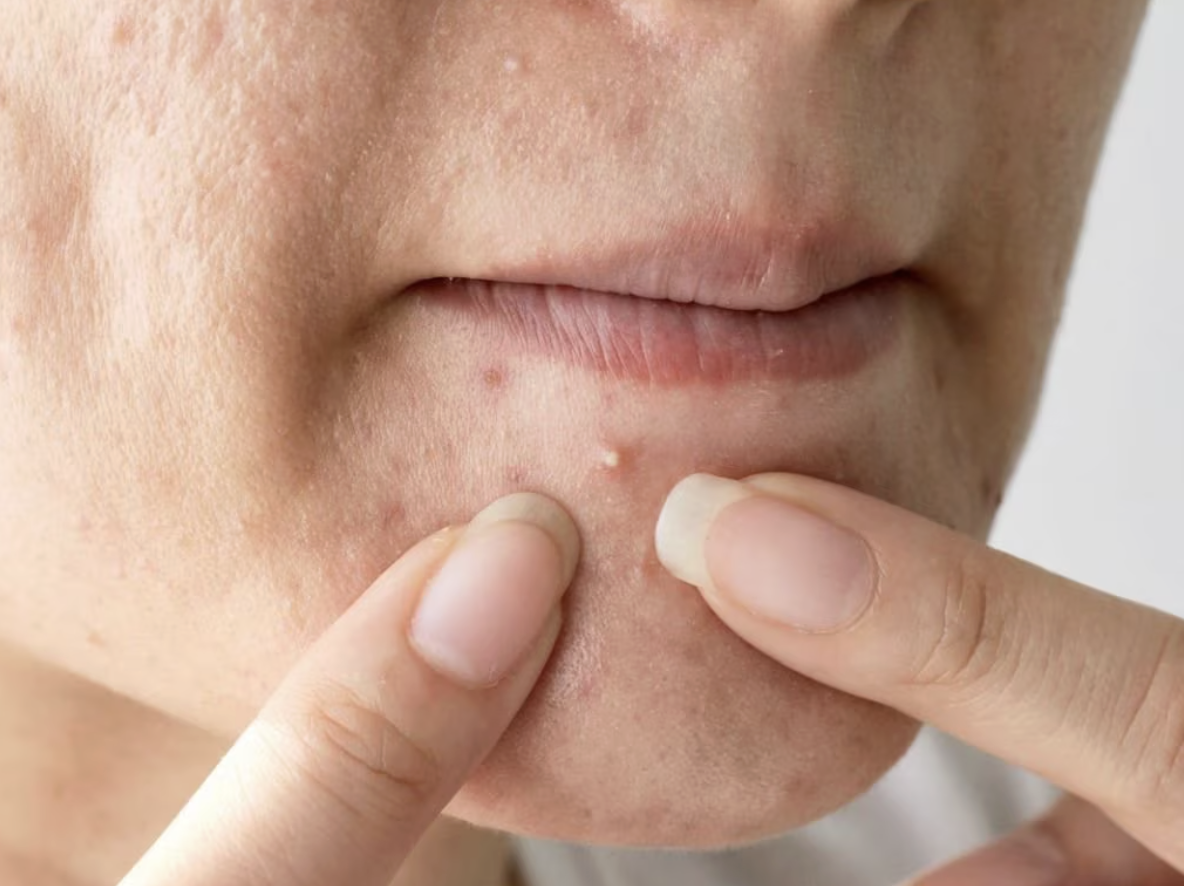 Mụn đầu trắng thường xuất hiện ở v&ugrave;ng da hay đổ dầu, nhờn