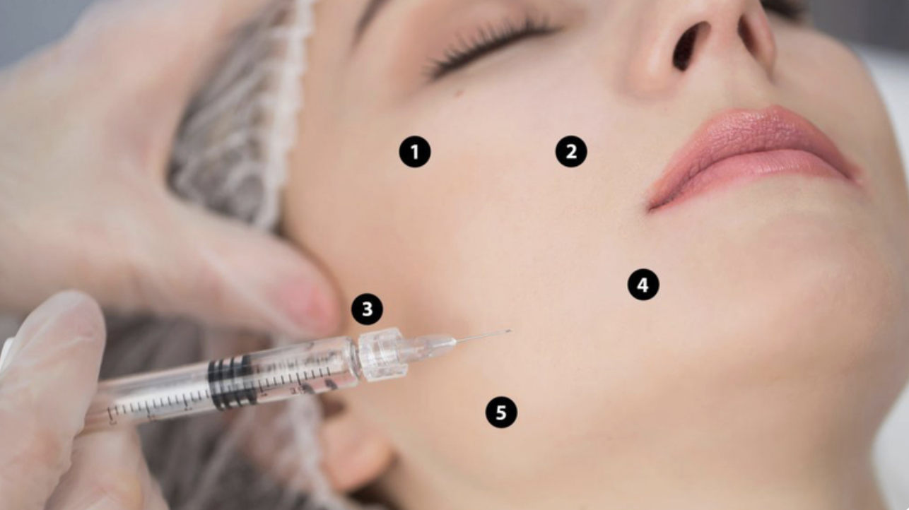Top 5 vị trí tiêm BAP tập trung vào trên da