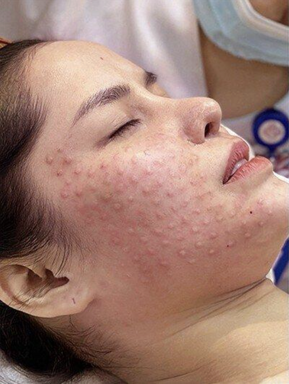 Tiêm meso trải đều trên da mặt 