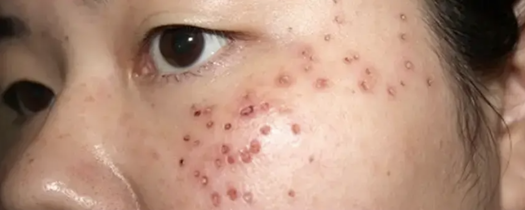 Vết đỏ sau khi đốt mụn thịt 