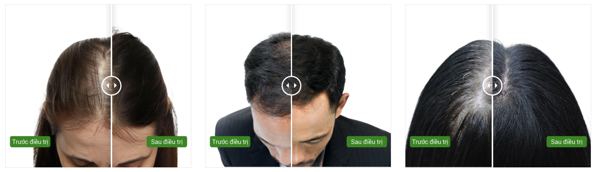 Khách hàng trải nghiệm tiêm meso mọc tóc tại Pro Skin