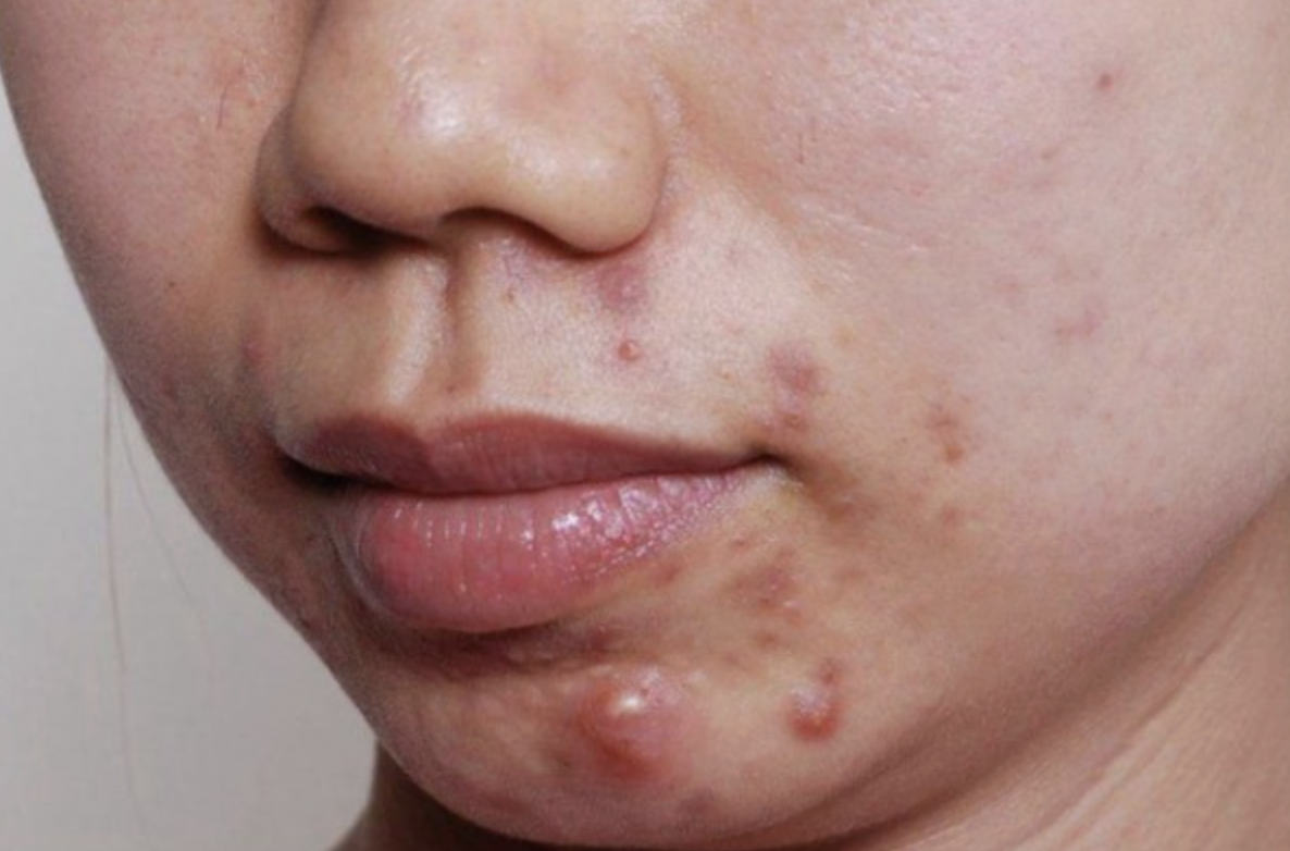 Mụn bọc vừa g&acirc;y đau đớn vừa ảnh hưởng đến thẩm mỹ