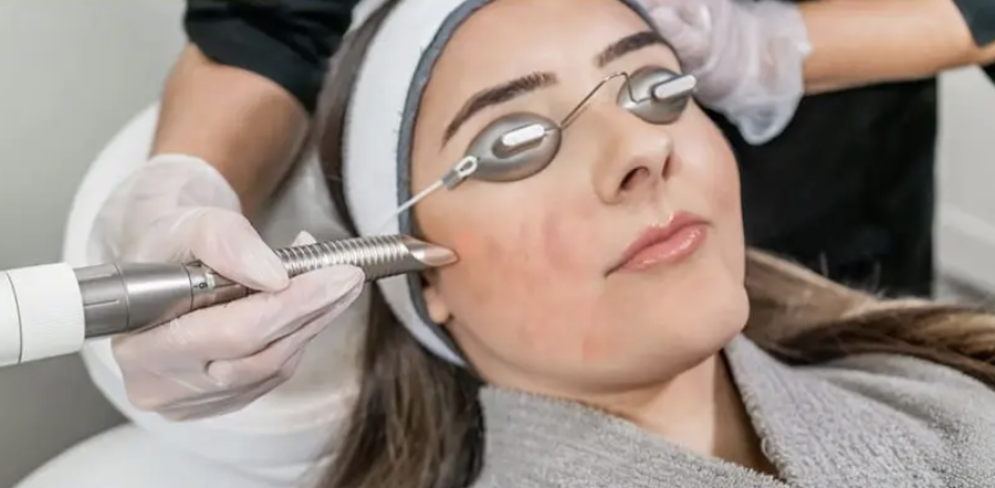 Trị thâm mụn bằng laser là giải pháp cải thiện làn da tối màu an toàn