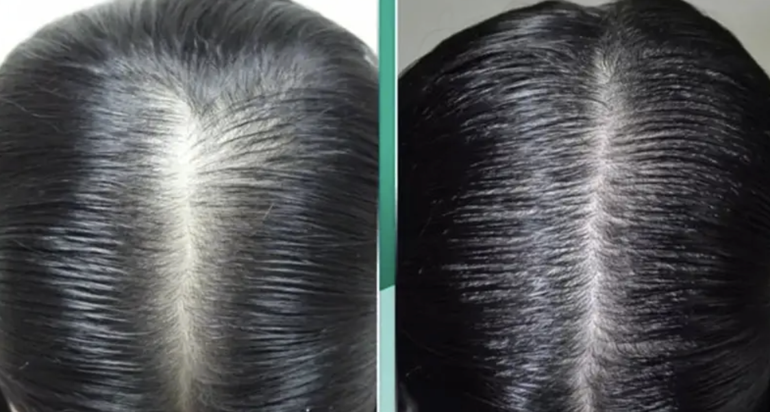 Tiêm trực tiếp dưỡng chất vào các nang tóc
