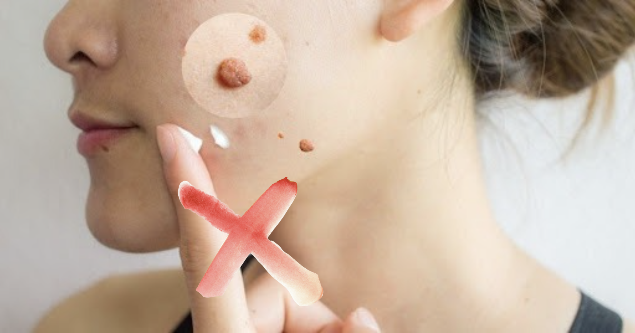 Mụn thịt l&acirc;u năm hay dạng to kh&ocirc;ng n&ecirc;n sử dụng thuốc b&ocirc;i để điều trị