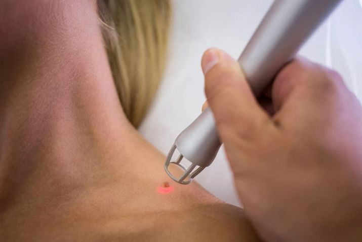 Bắn laser mụn thịt