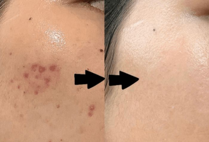 Kh&aacute;m da liễu v&agrave; ti&ecirc;m meso - Sự kết hợp ho&agrave;n hảo gi&uacute;p cải thiện to&agrave;n diện l&agrave;n da