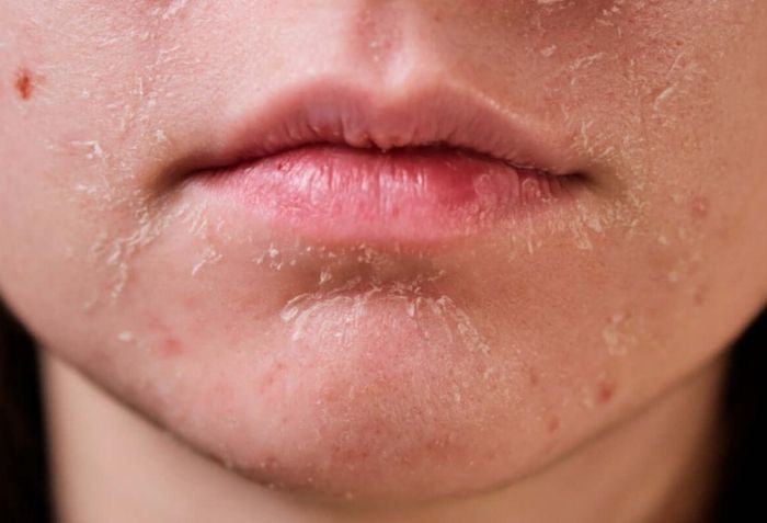 Những thay đổi thường gặp sau khi peel da