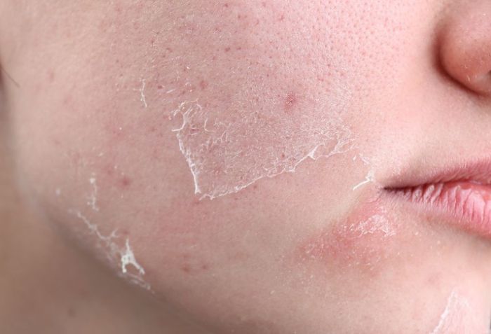 Cảm gi&aacute;c sau khi peel da vi tảo