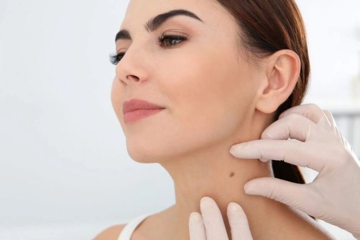 C&aacute;c loại nốt ruồi