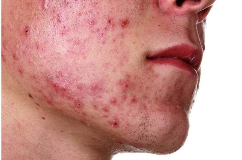 Thâm da mặt sau bị mụn có thể xảy ra ở nhiều mức độ khác nhau