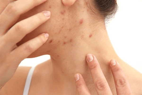 C&oacute; n&ecirc;n lo lắng khi mặt nổi nhiều mụn