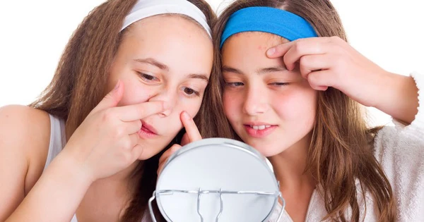 Từ lứa tuổi dậy th&igrave; đến 18 tuổi da c&ograve;n nhiều thay đổi