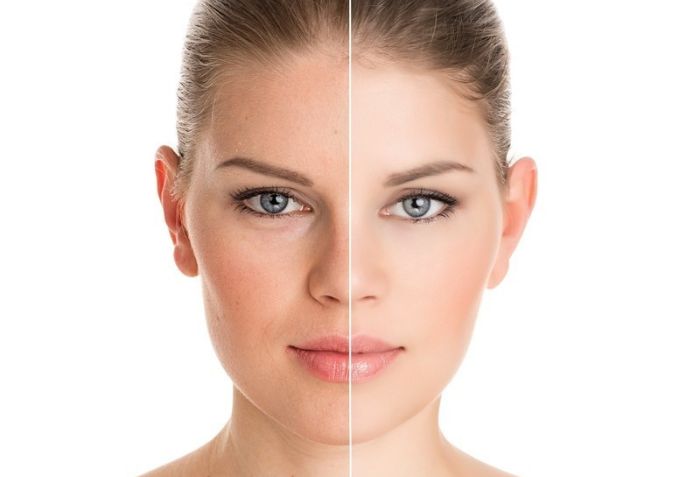 Tầm quan trọng của việc chăm s&oacute;c da sau trị mụn