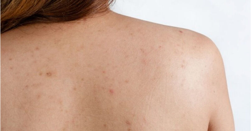 Dấu hiệu nổi mụn lưng