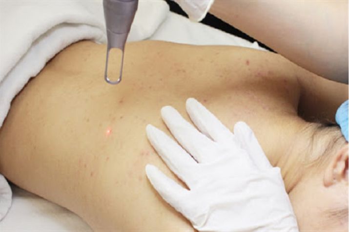 Điều trị mụn lưng