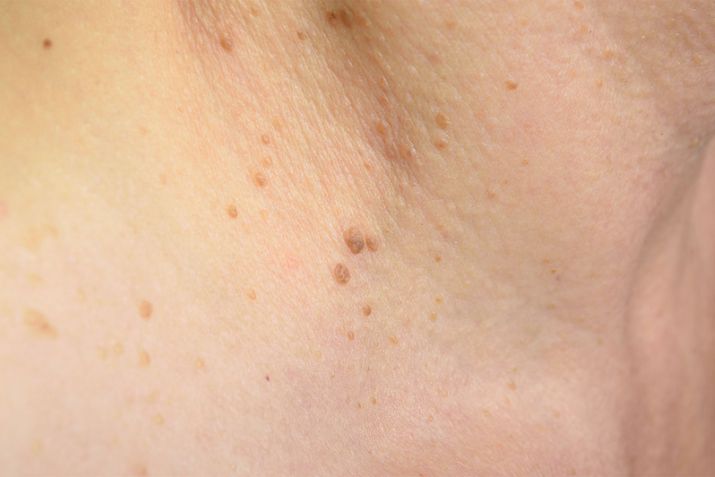 Mụn thịt l&agrave; g&igrave;? C&oacute; nguy hiểm kh&ocirc;ng?