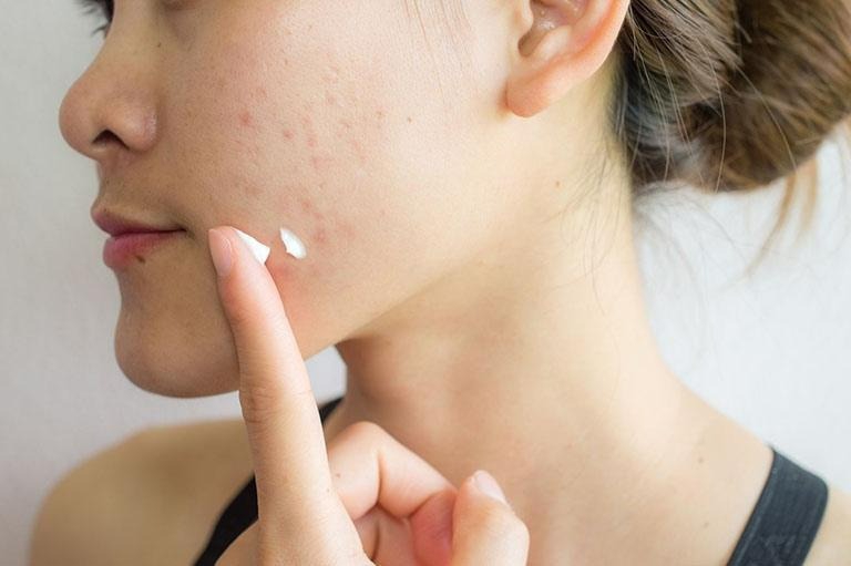 Bôi kem chống nắng là điều cực kì cần thiết cho làn da thâm mụn