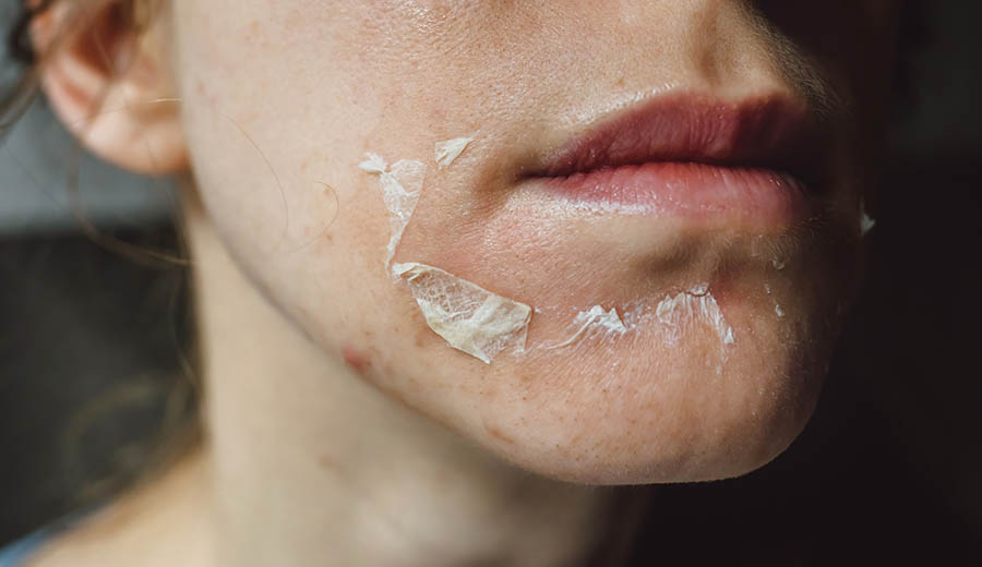 Những điều làm đơn giản hóa việc chăm sóc da sau peel