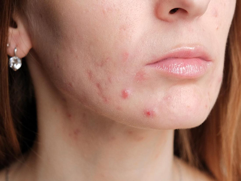 Mụn nội tiết ở quai hàm có cách điều trị hay không?