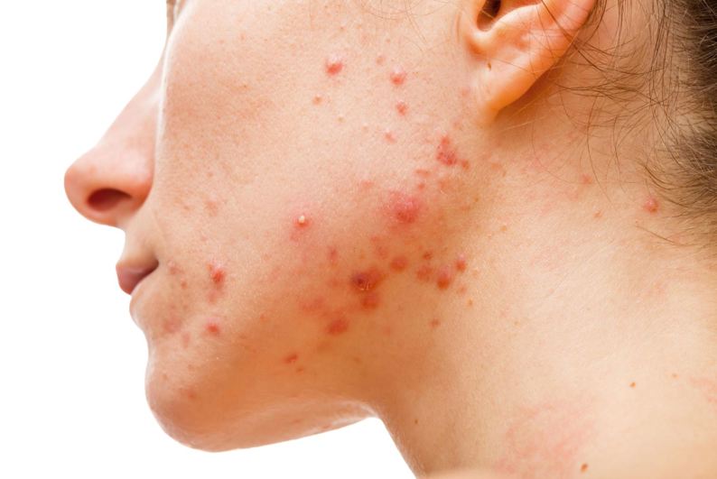 Mách bạn 8 mẹo phòng tránh mụn trứng cá