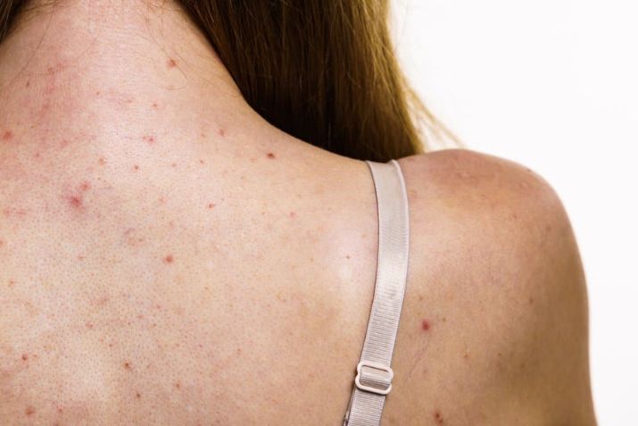 Nguyên nhân gây mụn lưng ở nữ giới là do đâu?