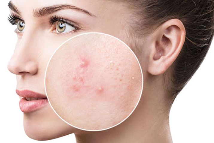 Bị nóng gan - uống thuốc mát gan có hết mụn không?