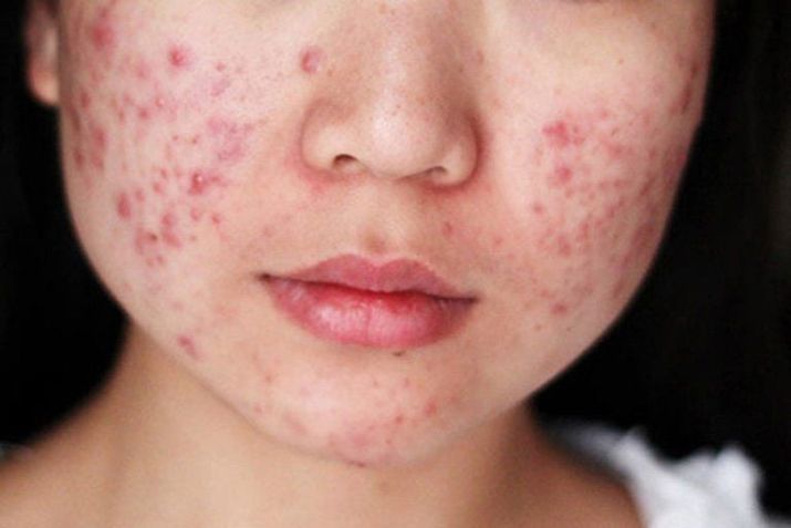 Da mặt đột nhiên nổi nhiều mụn có ảnh hưởng sức khỏe không?