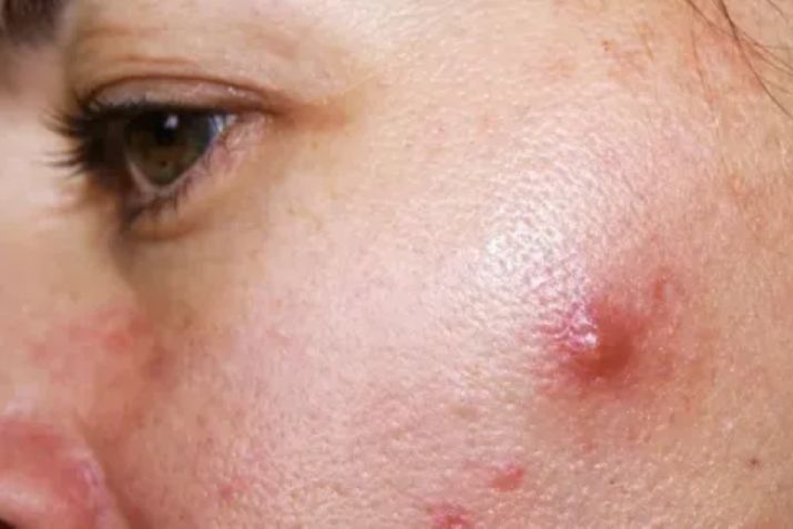 Mụn bọc không đầu có tự xẹp không cùng nhiều thắc mắc liên quan