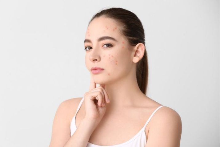 Góc thắc mắc: Uống vitamin C DHC có bị nổi mụn không?