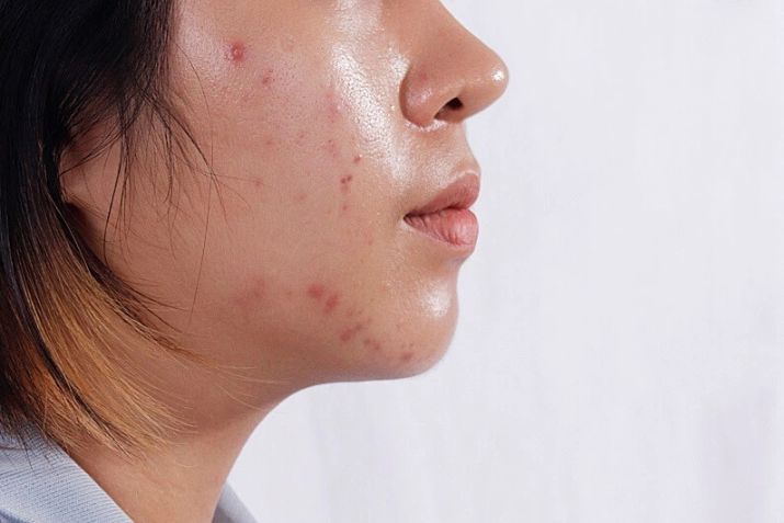Sản phẩm trị thâm mụn cho da dầu – bạn đã biết cách chọn chưa?