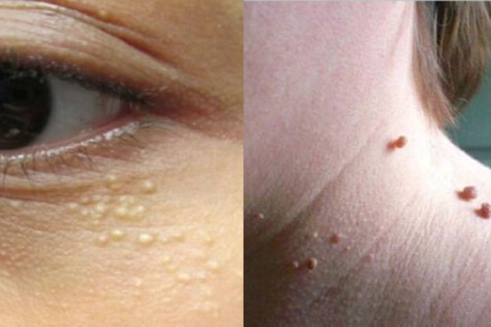 Bắn mụn thịt bao lâu lành? Cách chăm sóc da nhanh hồi phục