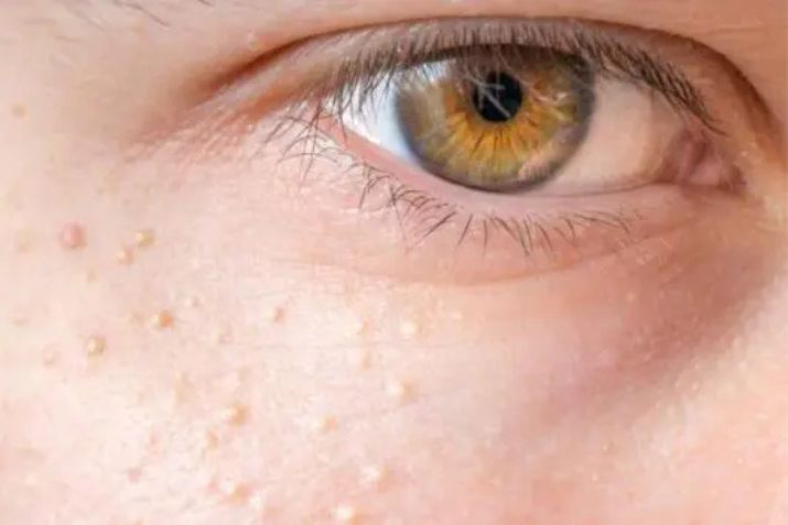 Cách trị mụn thịt quanh mắt – An toàn, dễ dàng, hiệu quả