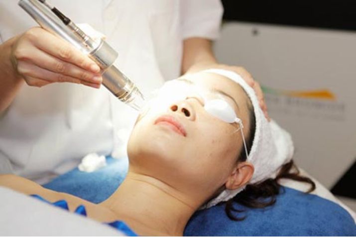 Đốt mụn thịt bao lâu thì hết thâm? Cách hồi phục và mờ thâm nhanh chóng