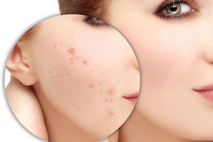 Tẩy nốt ruồi bị thâm có hết không? Những thông tin có lẽ bạn chưa biết