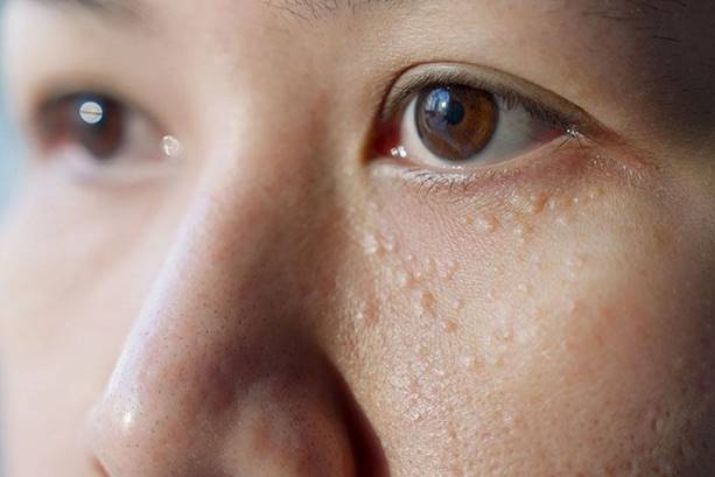 Góc chia sẻ: Kinh nghiệm đi đốt mụn thịt dành cho những ai đang cần