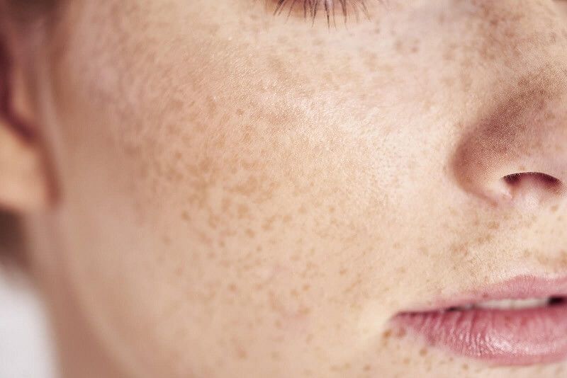 Liệu trình trị nám giá bao nhiêu? Có mắc hay không?