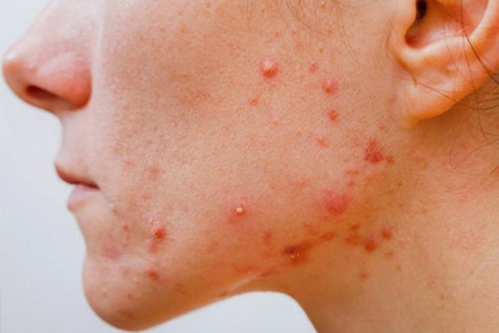Những nguyên nhân gây mụn viêm có thể khiến bạn bất ngờ