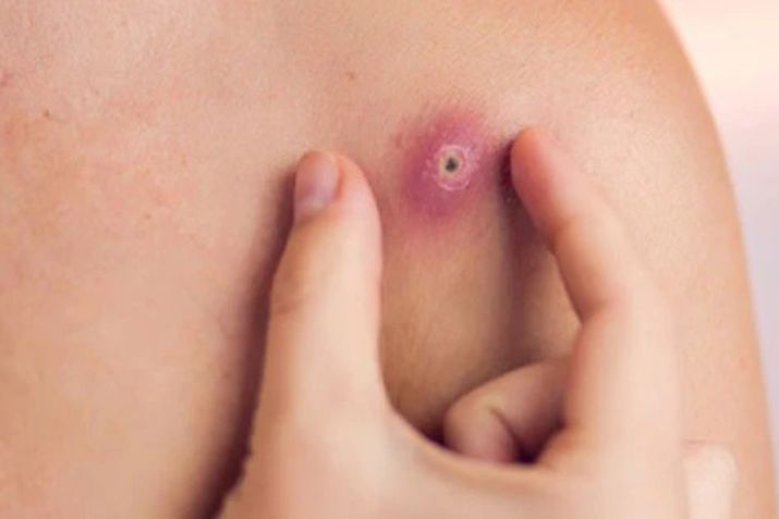 Mụn nhọt tái phát nhiều lần là do đâu?