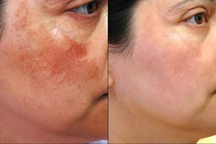 Bắn laser có an toàn không? Bắn laser trị nám bao lâu thì hết?