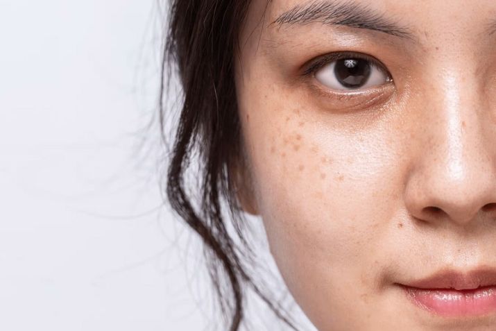 Nám chân đinh là gì? Tại sao bị nám chân đinh và cách điều trị thế nào?