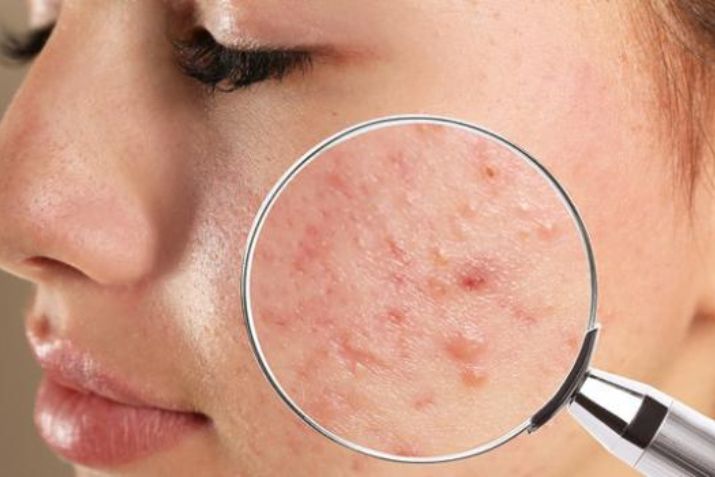 Mun nội tiết là gì? Tất tần tật những thông tin bạn cần biết
