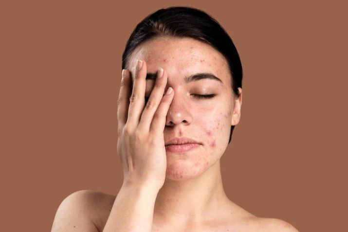 Cách trị mụn nội tiết dứt điểm, nhanh chóng, tiết kiệm