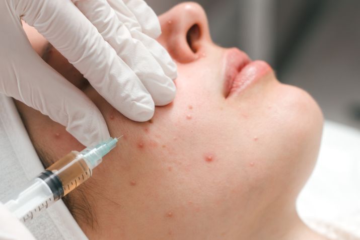 Tiêm meso trị mụn - liệu pháp an toàn, hiệu quả và không cần phẫu thuật