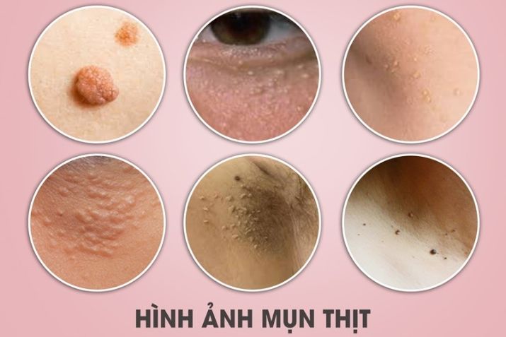 Top 3 hình ảnh mụn thịt phổ biến nhất trên cơ thể