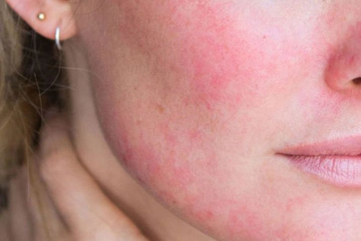 Cẩn thận với những biến chứng có thể gặp sau khi tiêm meso