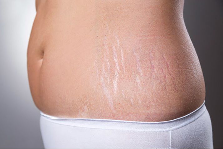 Tiêm meso trị rạn da - Cứu tinh cho phụ nữ sau sinh